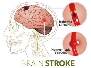 Post-stroke paralysis curative therapy